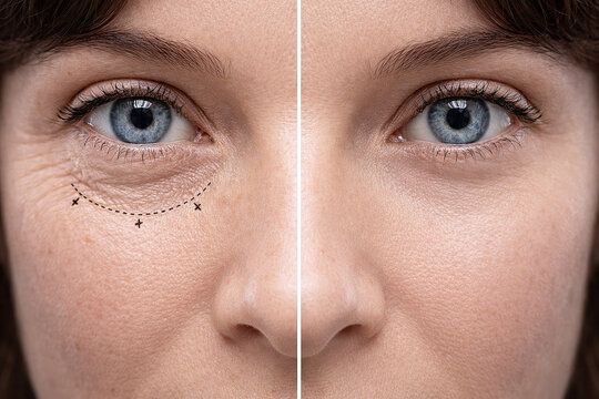 Female face before and after blepharoplasty, cosmetic eyelid surgery result showing lifted eyelids, rejuvenation, beauty transformation.