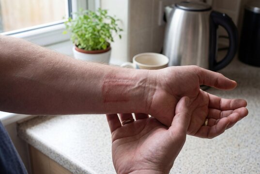 Close-up of a person's arm showing a rectangular red burn mark on the wrist
