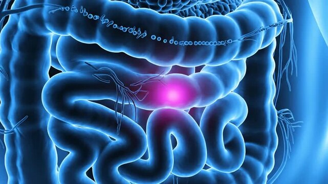 Medical animation showing inflamed intestine, highlighting potential health issues and awareness