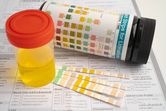 Urinalysis, urine cup with reagent strip pH paper test and comparison chart in laboratory.