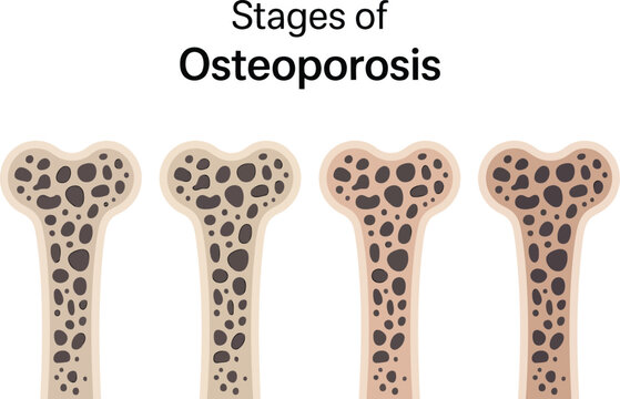 Medical illustration showing the early stages of osteoporosis with four bone cross sections