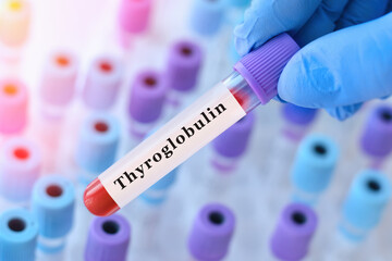 Fototapeta premium Doctor holding a test blood sample tube with Thyroglobulin test on the background of medical test tubes with analyzes.