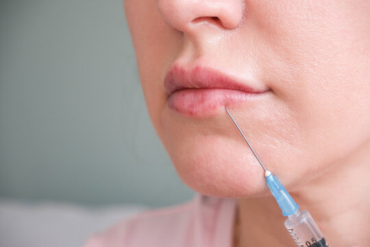 A woman gets hyaluronic acid injected into her lips.