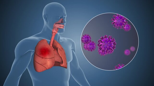 Nipah Virus Infection Growing Inside Human Lungs