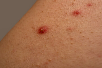 Naklejka premium Close up pimple with acne skin problem and pores background. Acne close up with pimple, blackhead, and sebum detail. Pimple acne close up for dermatology. Close up acne skin issue with papules.
