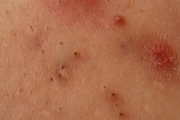Fototapeta premium Acne close up pimple with blackhead pores and sebum on skin. Pimple close up acne skincare texture detail for puberty skin issue. Pimple in acne with pustule. Acne close up with pimple and scar.