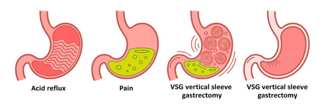 Anatomical illustrations of stomachs with various conditions and surgical procedures