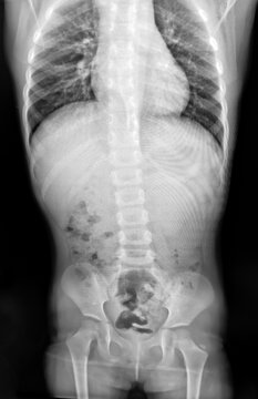 abdomen, abdomen supine, abdomen upright, abdominal, anatomy, appendectomy, appendix, bone, bowel, bowel obstruction, care, chest, chest ap, clinical, colon, diagnosis, digestive, disease, doctor, exa