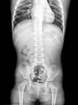 abdomen, abdomen supine, abdomen upright, abdominal, anatomy, appendectomy, appendix, bone, bowel, bowel obstruction, care, chest, chest ap, clinical, colon, diagnosis, digestive, disease, doctor, exa