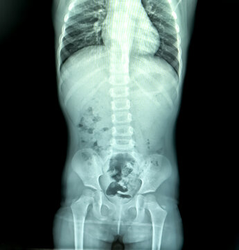 abdomen, abdomen supine, abdomen upright, abdominal, anatomy, appendectomy, appendix, bone, bowel, bowel obstruction, care, chest, chest ap, clinical, colon, diagnosis, digestive, disease, doctor, exa