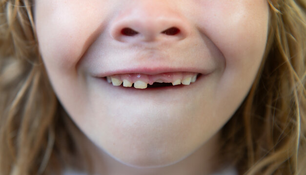 Smiling child with missing teeth. Kid showing tooth gap. Closeup of baby teeth. Child losing milk teeth. Child mouth with new teeth. Kid with toothless smile. Kids missing tooth. Child dental concept.