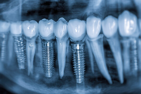 Detailed dental X-ray revealing natural teeth alongside metal-based dental implants embedded in the jaw for restorative oral health evaluation