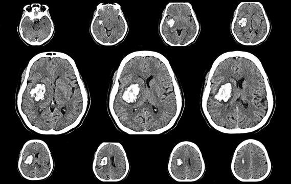 CT scan brain image showing intracerebral hemorrhage stroke