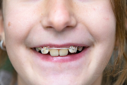Close-up on girl's teeth, orthodontic plate visible, device for tooth alignment and bite improvement.