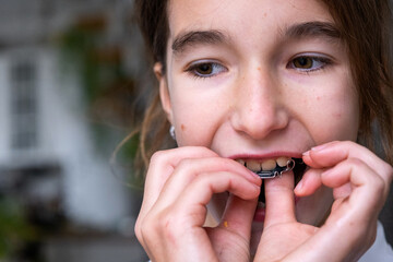 Step-by-step child orthodontics: girl positioning her dental plate appliance in mouth for teeth and jaw alignment. © Ольга Симонова
