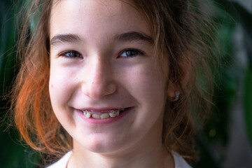 Fototapeta premium Happy dental patient, schoolgirl after orthodontic treatment, shows teeth improvement with removable expander.