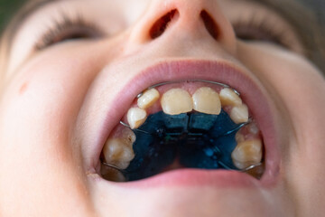 Extreme close-up: upper jaw with blue orthodontic expander, pediatric palate correction device visible. © Ольга Симонова