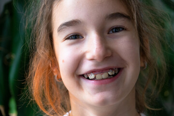 Fototapeta premium Portrait: Girl age 9 after using orthodontic plate, positive change in teeth and bite alignment, pediatric care.