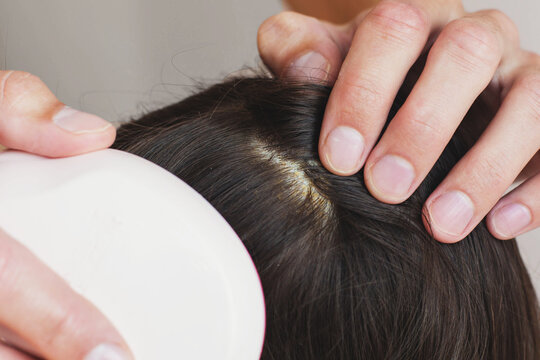Close up view of dark brown hair with visible dandruff flakes  seborrheic dermatitis on scalp, hands parting strands to show irritation, lice infestation and dermatology   hygiene themes