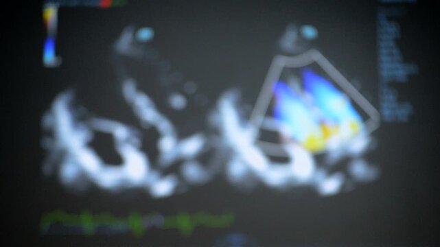 Blurred background. Ultrasound image on monitor. Ultrasound Scan display. Screening Ultrasonography Analysis of person. Ultrasound examination Using Scanner. Ultrasound Scan Device. Echocardiography