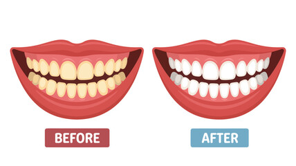 Fototapeta premium Dental care illustration showing before and after teeth whitening treatment on a dental model from a close-up frontal viewpoint