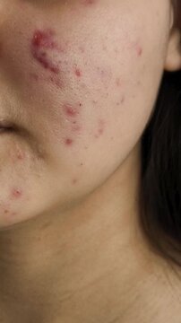 Acne on the face of a young woman. The problem of acne, acne in teenagers. Dermatological diseases of the skin of the face