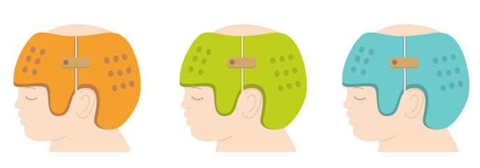 頭の形を治すためにヘルメットを被るアジア人の赤ちゃんのイラスト