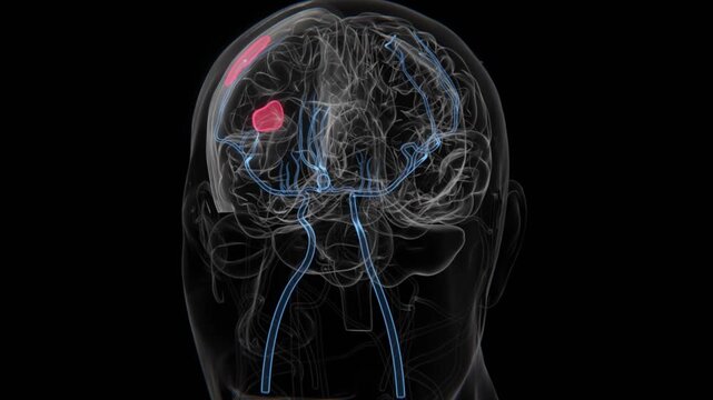 Hemorrhagic Brain Stroke in HD Video | Stroke Hemorrhagic HQ Video | Brain Stroke