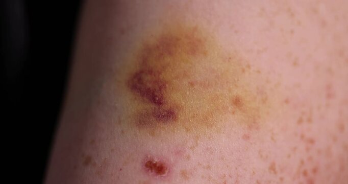 a man's arm with bruises from a blow, the damaged part of a man's arm with red and yellow bruises and healing scratches