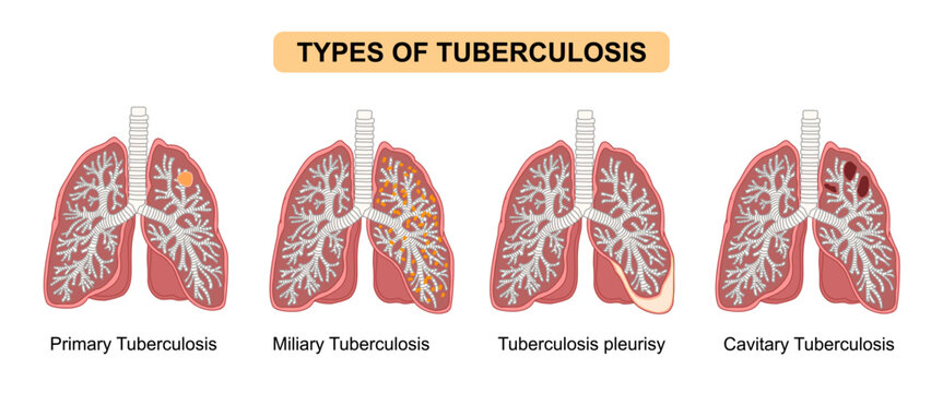 Types of Tuberculosis in Human Lungs, Primary, Miliary, Pleural and Cavitary Tuberculosis. vector illustration for education, medical awareness campaign, science, and medical poster.