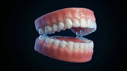 Fototapeta premium Invisible Aligners for Perfect Teeth and Oral Health