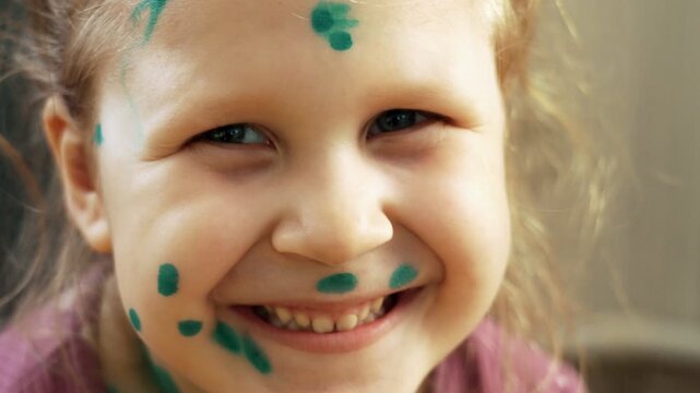 Funny portrait of a little girl suffering from chickenpox at home, blisters on her face treated with antiseptic ointment. The child easily tolerates the disease. Varicella.