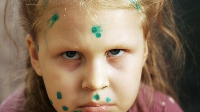 A sad portrait of a little girl suffering from chickenpox at home, blisters on her face treated with antiseptic ointment. The child easily tolerates the disease. Varicella.