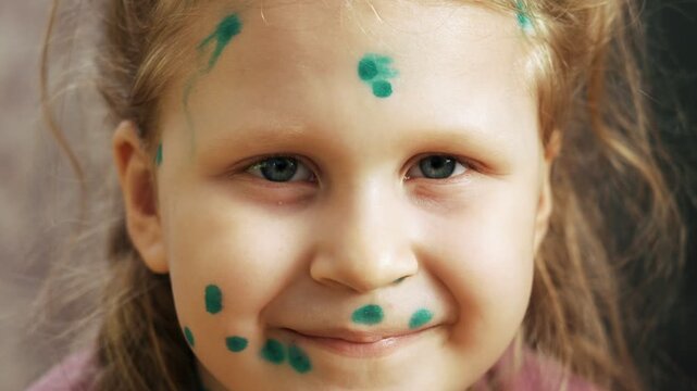 Funny portrait of a little girl suffering from chickenpox at home, blisters on her face treated with antiseptic ointment. The child easily tolerates the disease. Varicella.