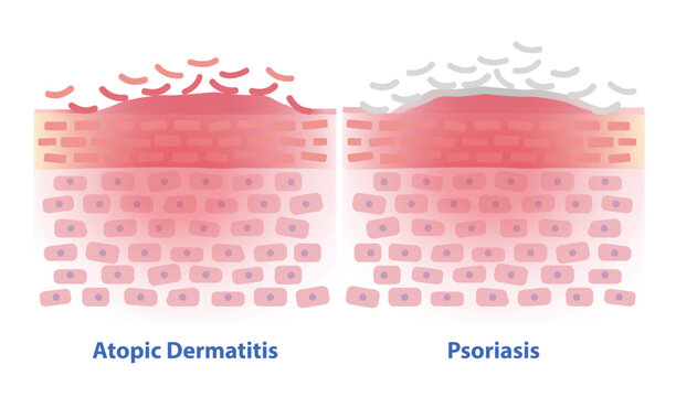 Comparison of Atopic Dermatitis and Psoriasis skin vector illustration. Cross section of skin barrier layer eczema, dry, itchy, red, inflamed skin and Psoriasis plaques are thick, silvery scales.