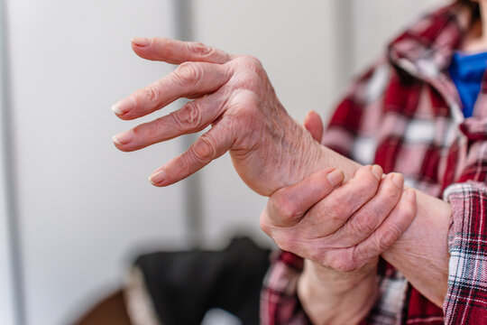 An elderly woman with rheumatoid arthritis on her hands, joint damage
