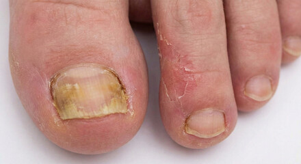 Obraz premium Nail fungus. Toenail fungus on the toenail on white background,treatment