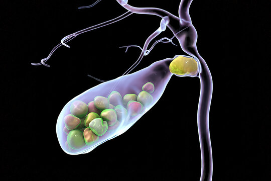 Gallbladder diseases infographic banner. Gallstone disease, cancer, cholangitis or polyps of the digestive system. Medicine and healthcare. Illustration.
