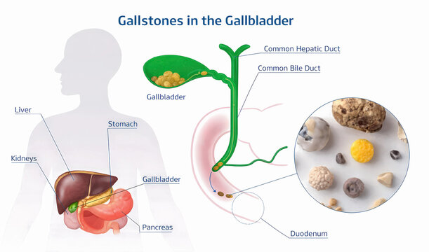 Gallbladder diseases infographic banner. Gallstone disease, cancer, cholangitis or polyps of the digestive system. Medicine and healthcare. Illustration.