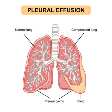 Medical illustration of lung disease pleural effusion. Fluid in the lungs. Fluid accumulation in the lung cavity. Vectors for medical, respiratory diseases, educational, and posters.