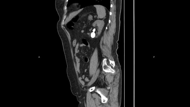 Multiplanar abdominal CT imaging in sagittal, coronal, and axial views demonstrating unilateral renal agenesis with absence of one kidney and compensatory contralateral renal anatomy.