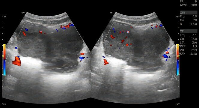 Transabdominal ultrasound imaging of the uterus demonstrates a well-defined intrauterine mass with internal vascularity on color Doppler evaluation, suggestive of a solid uterine lesion requiring furt