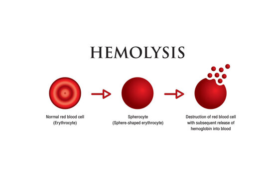 Hemolysis. Normal red blood cell, spherocyte, then destruction of red blood cell with subsequent release of hemoglobin into blood. Vector illustration