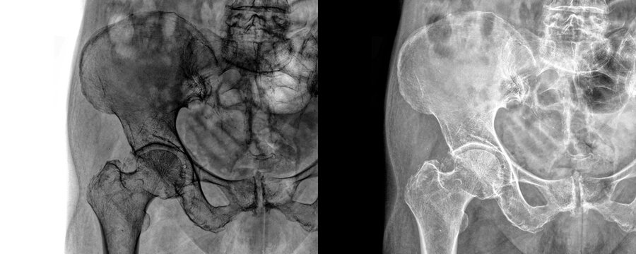 Diagnostic Hip Joint Anterior Projection X-ray Image Displaying Acetabulum and Femoral Anatomy for Hip Preservation Surgery, Drainage Procedures, and Clinical Assessment Isolated on Transparent 