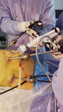 Laparoscopy team guides tools through trocar ports on draped abdomen. Surgeon moves handles while nurse manages tubing to maintain suction