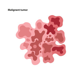 Illustration of a malignant tumor with irregular shapes and varying shades of red