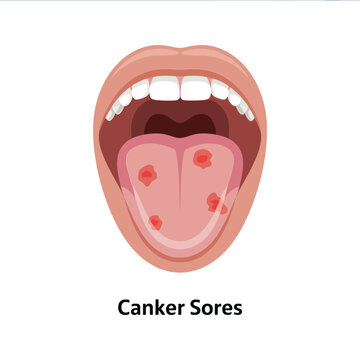 Illustration depicting an open mouth showing a tongue with multiple canker sores