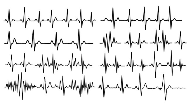Ecg electrocardiogram heart rate monitor patterns