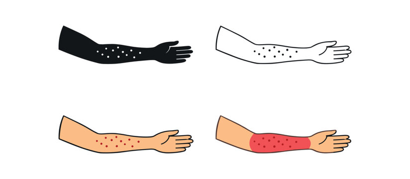 Human forearm with rash dots scattered across skin surface for allergic reaction icon set four styles: black solid silhouette thin black outline flat colored anatomical illustration and