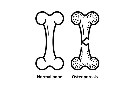 Bone osteoporosis illustration showing normal and affected bones